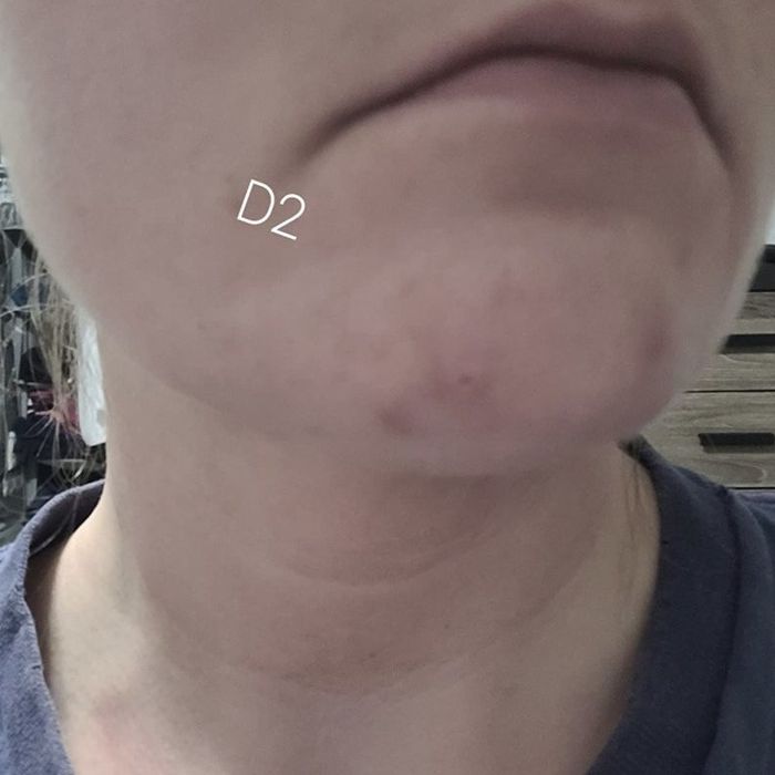 The third day of an acne scar