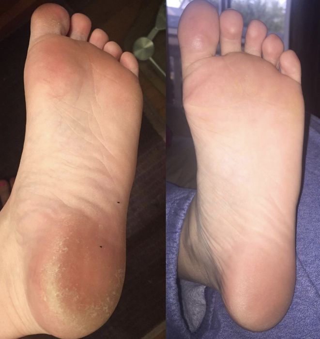 Before and after a foot treatment with the peel mask, showcasing the transformation.