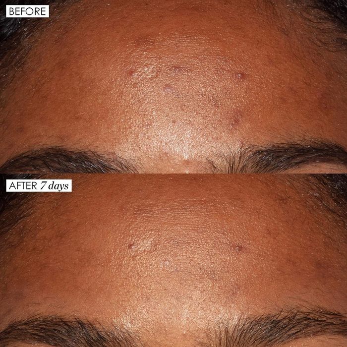 A model showing a noticeably clearer forehead after just seven days of using the serum.