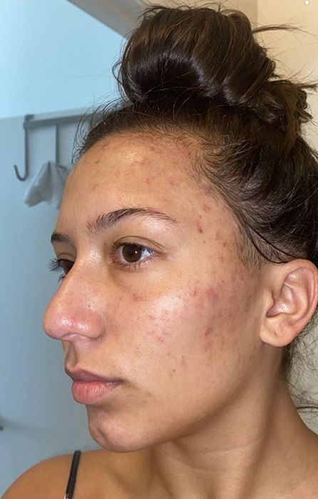 A person struggling with acne before using the cleanser.