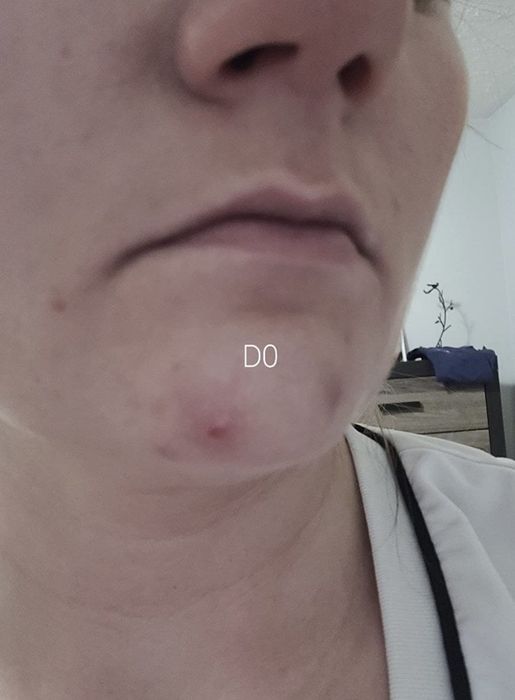 The first day of an acne scar