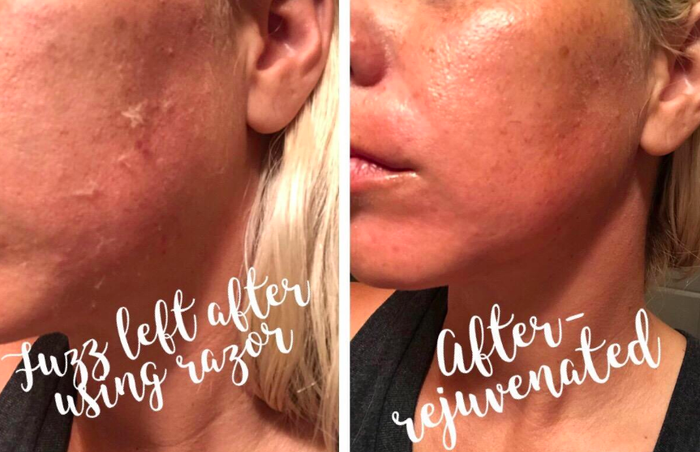 A customer’s before-and-after photo showing the improvements after using the razor on their skin.