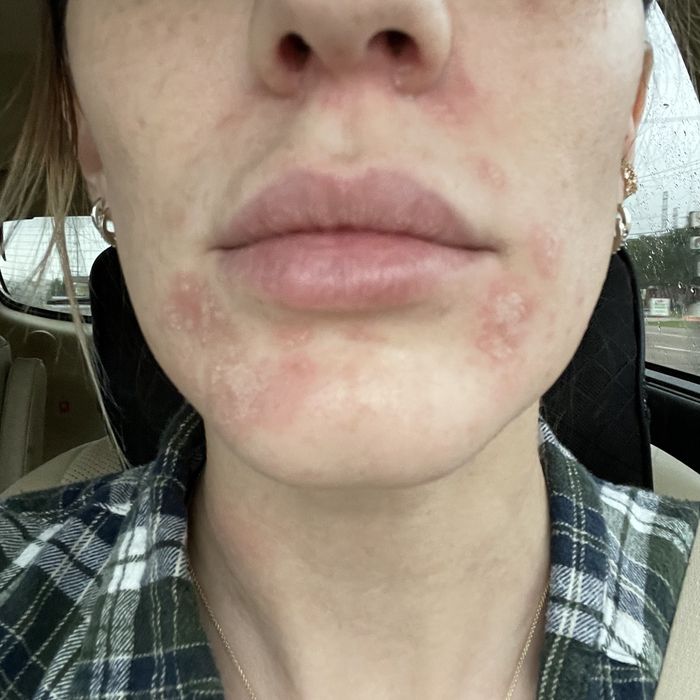 A reviewer's before photo, showing their skin before the treatment.