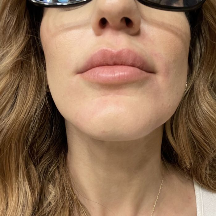 A reviewer's after photo, now enjoying clear, refreshed skin thanks to the device.