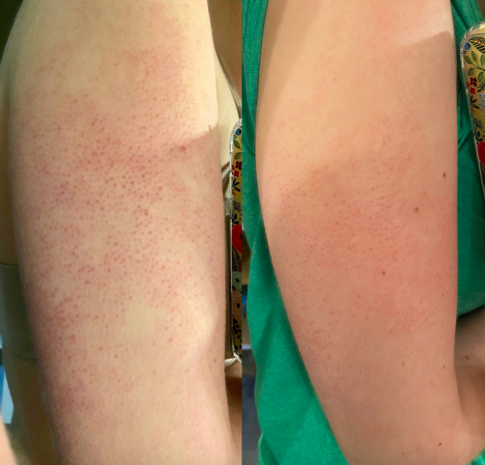A customer’s before-and-after photo showing their arms after using the KP Bump Eraser Body Scrub.