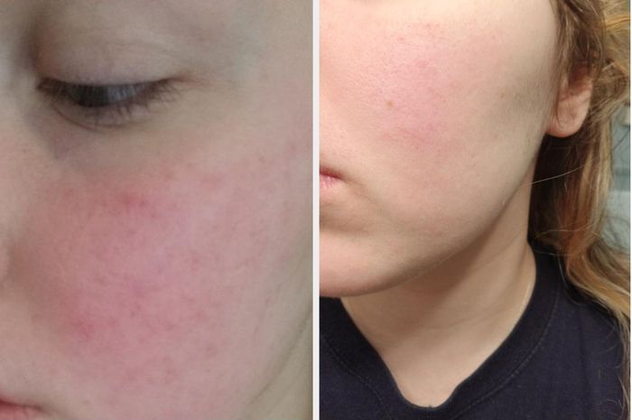 A reviewer's before-and-after photo showcasing significant reduction in redness.