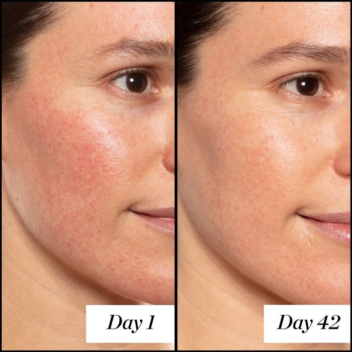 A model showing redness on her cheeks, followed by the same model 42 days later with the redness diminished
