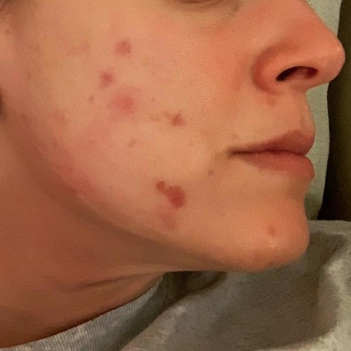 A reviewer's image showing breakouts before using the acne patch