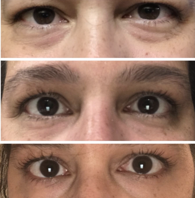 A reviewer shows their under-eye area with puffiness and irritation, followed by a smoother, bag-free look after consistent use over time.