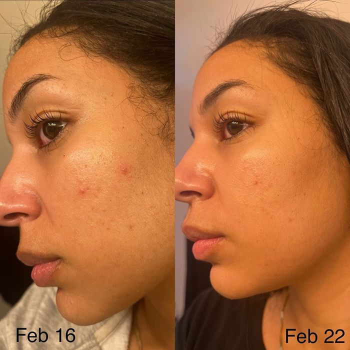 A reviewer shows the before and after of her skin