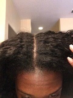 A post-use image of the reviewer’s scalp, now completely free of dandruff.