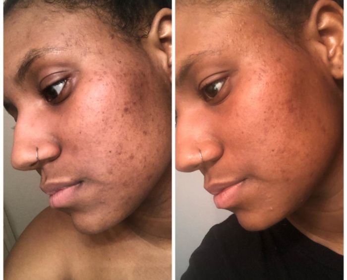 A reviewer demonstrating the exfoliant's effects on their hyperpigmentation
