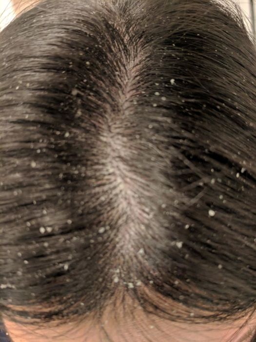 A reviewer's scalp showing a significant amount of flakes