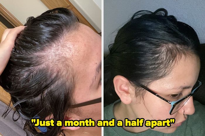 A reviewer’s thinning hairline before, and a fuller hairline a month and a half later