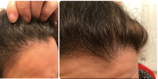 Left: A reviewer showing a hairline full of white flakes / Right: The same reviewer's hairline now smooth, with all flakes gone