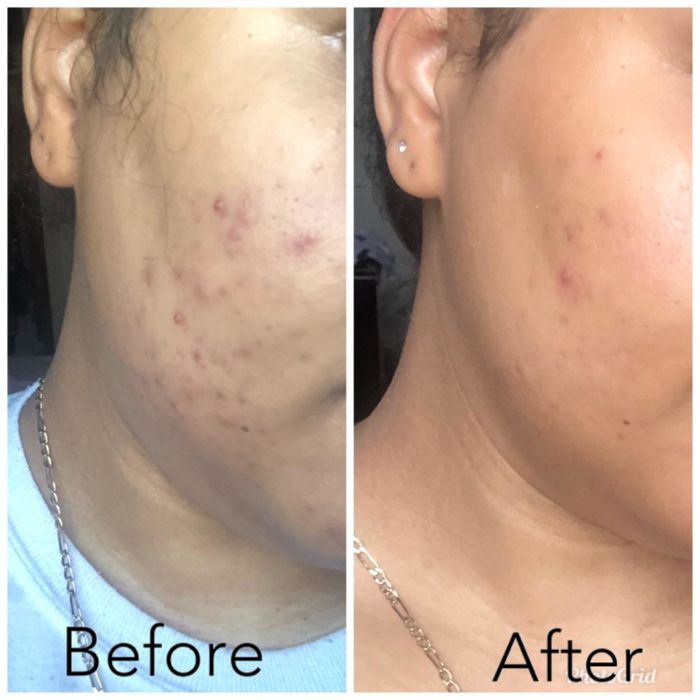 A before and after from a reviewer, showing how the exfoliant significantly reduced hyperpigmentation on their cheek while making the skin smoother