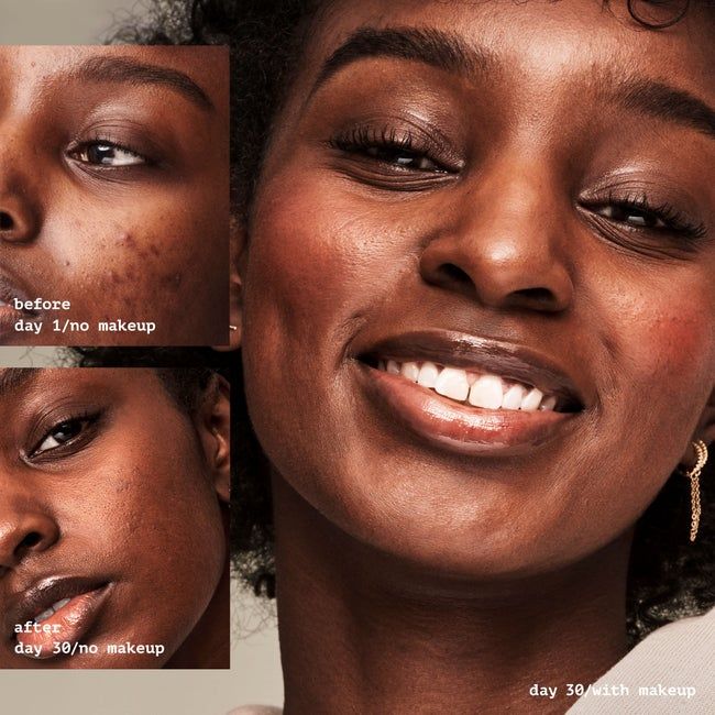 model showing before and after 30 days of using the primer, with visible improvement in their acne