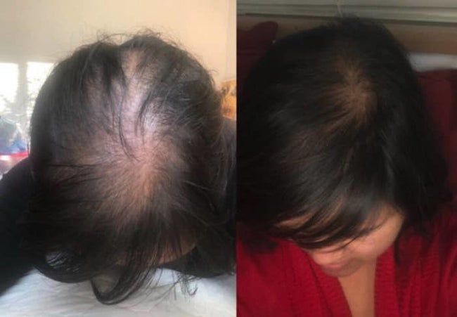A before-and-after comparison of a reviewer showing a balding spot on their head that has nearly fully grown back after using the product.