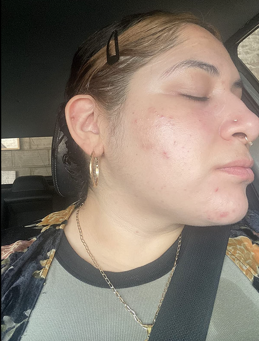 reviewer showing their face with visible blemishes before using the product