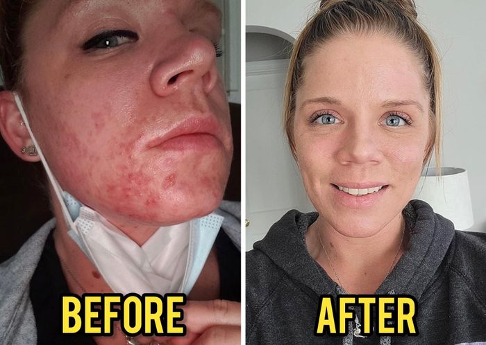 Before-and-after photos of a reviewer showing improved skin condition. The left side displays acne, while the right side shows clearer skin, both labeled accordingly.