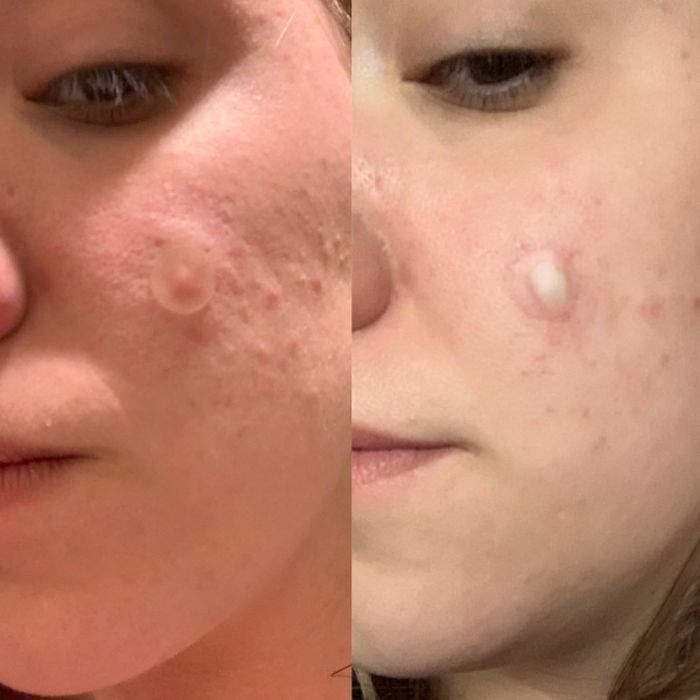 Before and after photo of a reviewer showing how the patch effectively drew out pus from a pimple.