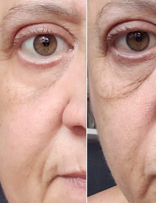 A reviewer's before and after photos showing a significant reduction in puffiness under their eyes.