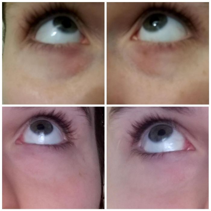 A reviewer's before and after photos showing how the eye stick reduced puffiness and under-eye bags.