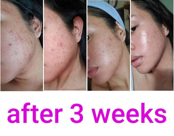 A photo progression showing a reviewer's acne improvement over three weeks. The reviewer’s skin transitions from numerous red blemishes to significantly clearer skin. Text reads: 