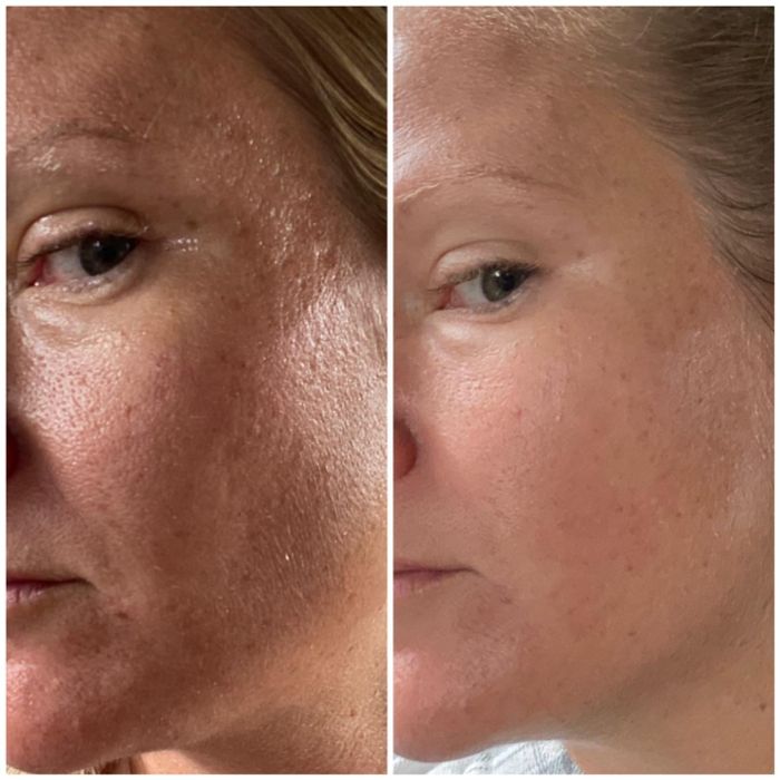 Before and after pictures of a reviewer showing visibly large, clogged pores in the first image, followed by clean, clear skin with reduced pores in the second.