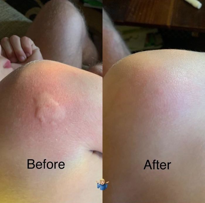 Before and after images of a reviewer's mosquito bite; in the first image, a swollen bite is visible, while in the second image, the bite is gone.