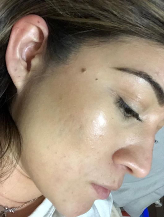 After picture of the same reviewer with clear, smooth skin.