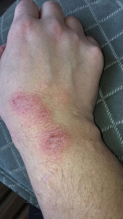Before photo showing a wrist with visible eczema scars.