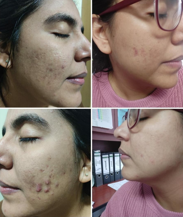 Before and after pictures of a reviewer, first showing acne and acne scars, then clear skin after using the treatment