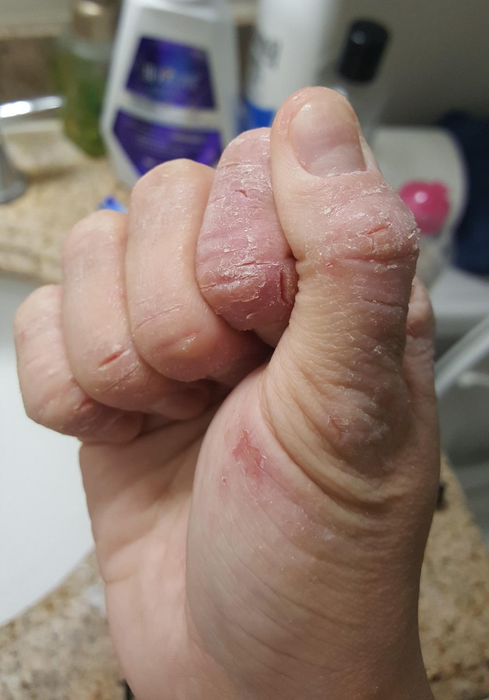 Before picture of the reviewer with eczema on their hand.