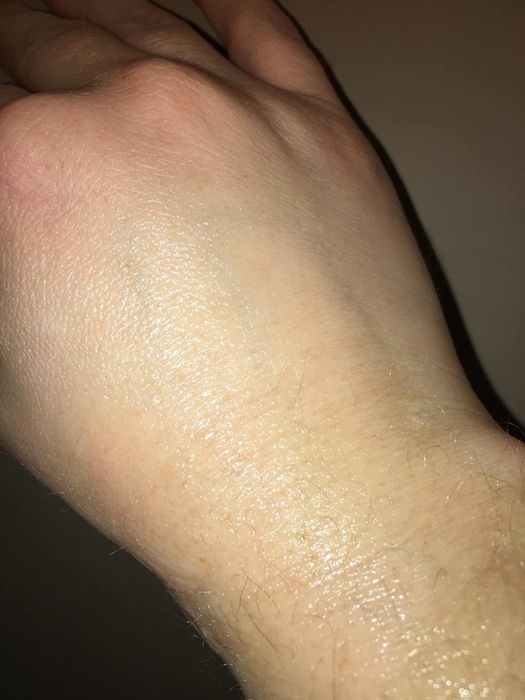 After photo of the same wrist now completely scar-free.