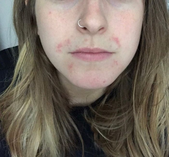 Before photo of the reviewer with a dermatitis flare-up around their mouth.