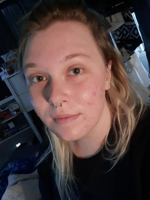 After image of the reviewer with noticeably clearer skin