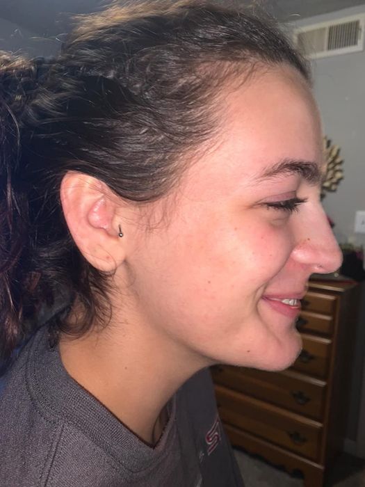 The same reviewer's face now completely free from acne.
