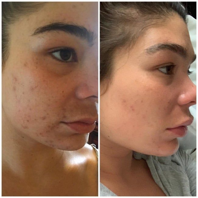 Before and after pictures of a reviewer with dark acne patches and scars on her cheek, showing how the mask significantly reduced hyperpigmentation and cleared breakouts