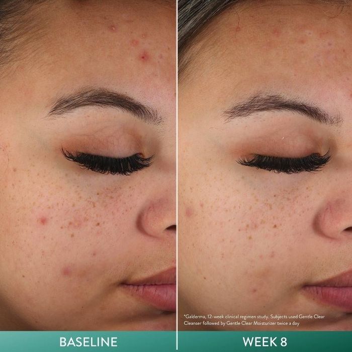 A person showing before and after images of their face
