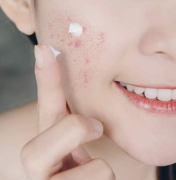A person applying Neutrogena spot treatment gel to their cheek