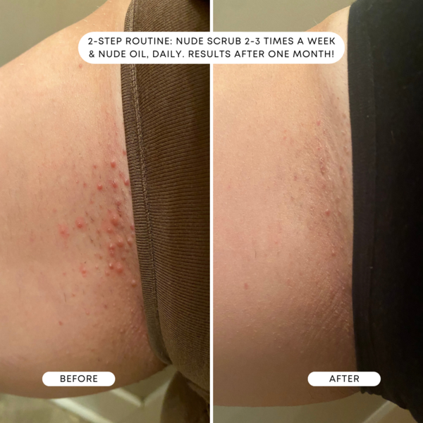 A before and after photo showing the reviewer’s razor bumps significantly reduced after a month of using the oil.