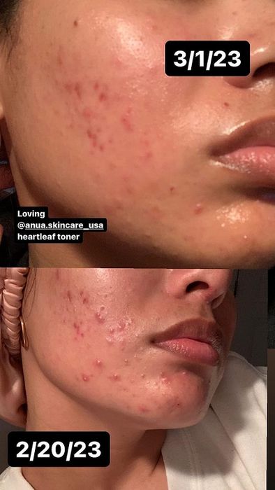 Before image showing a reviewer with red skin and acne, and an after image showing significantly reduced redness and acne