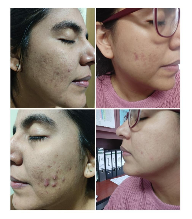 side-by-side before-and-after photos of a reviewer with acne and scars, followed by clear, smooth skin