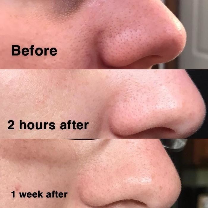 A progression photo from the reviewer showing the blackhead remover gradually shrinking their pores over the course of several days