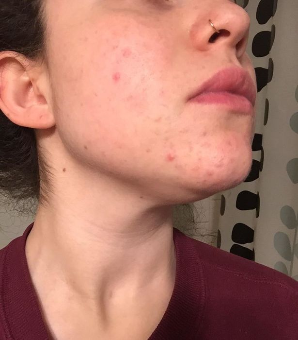 After photo of the same reviewer showing a noticeable reduction in redness and breakouts after using the mask