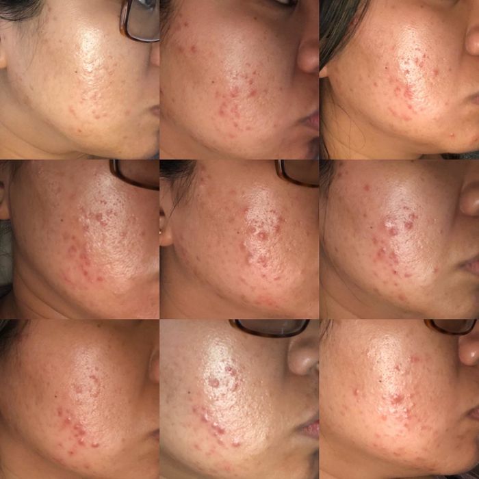Reviewer progression photos showing their acne gradually clearing up over time with the gel's use