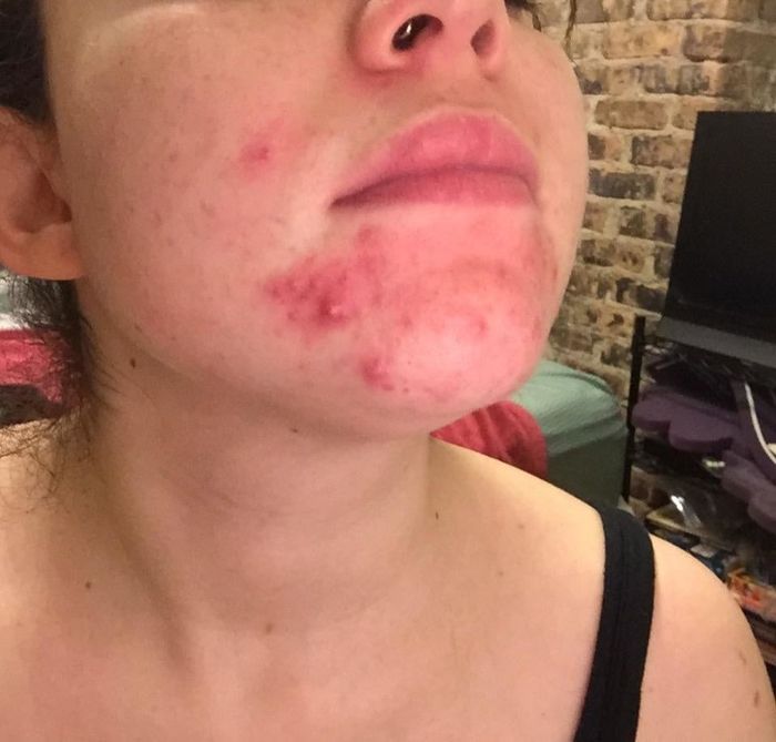 Before photo of a reviewer with red, irritated breakouts on their chin and around their mouth
