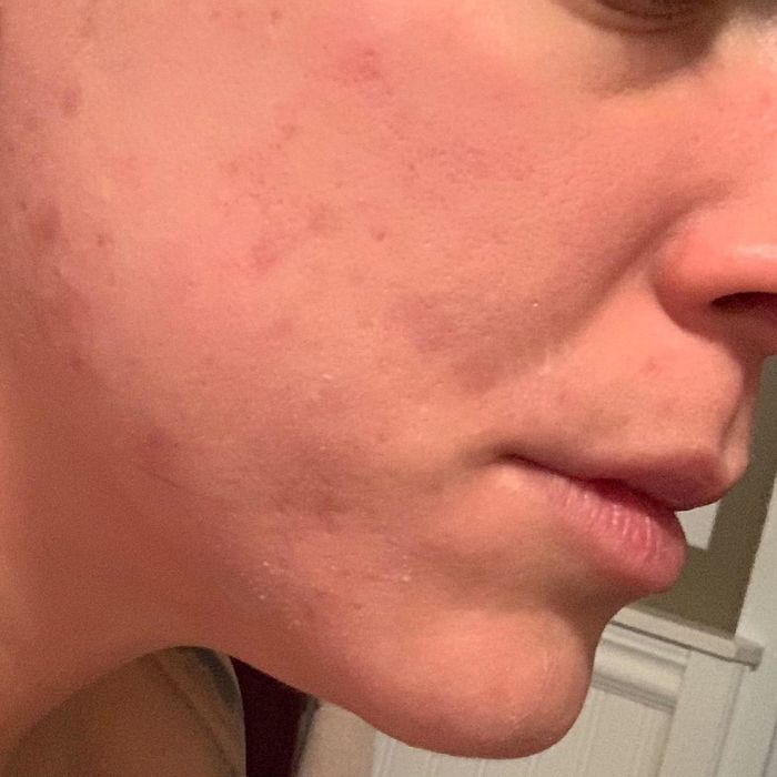 After photo of the same reviewer showing a significant reduction in acne scars and fewer breakouts thanks to the patches