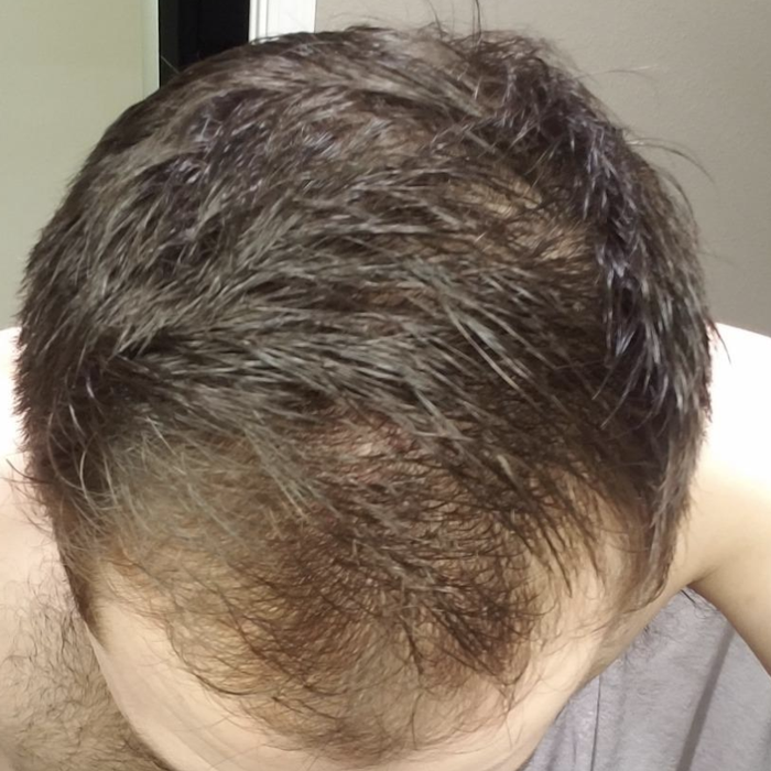 Top-down image of reviewer showing signs of hair thinning on the scalp